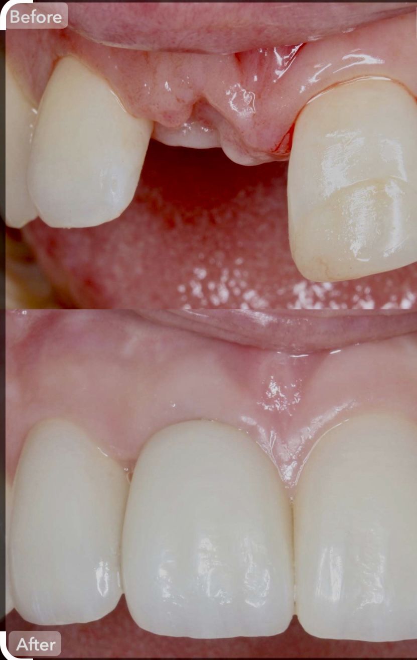 Dental Implants Dentist in Pasadena