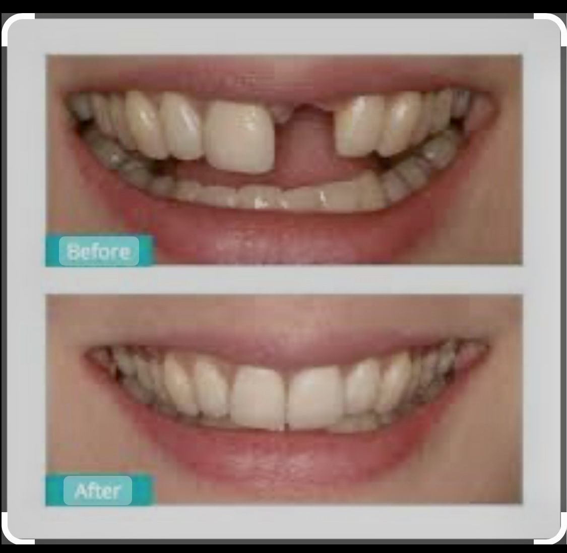 Belle Smile | Orthodontics, Implant Supported Overdentures and TMJ Disorders